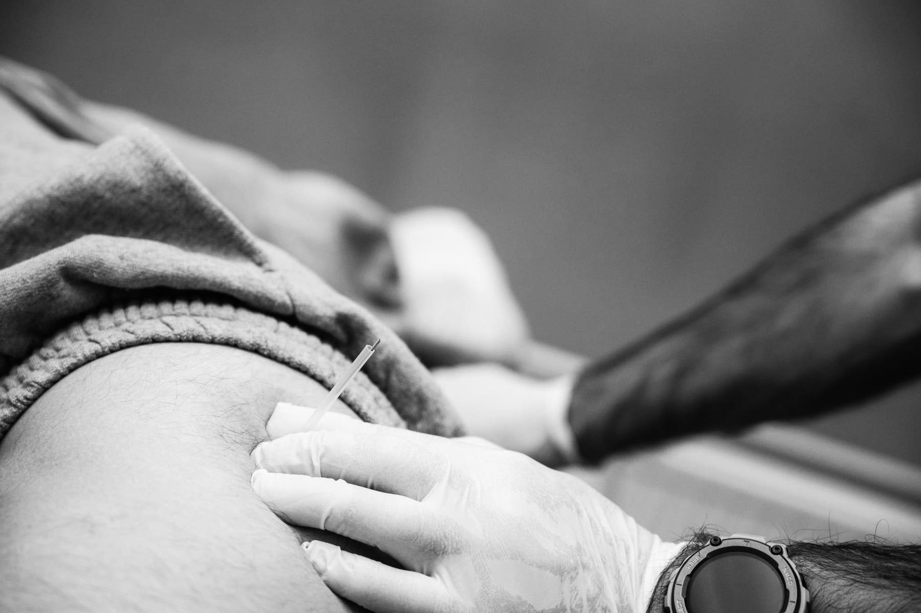 Dry needling terapija Tuzla