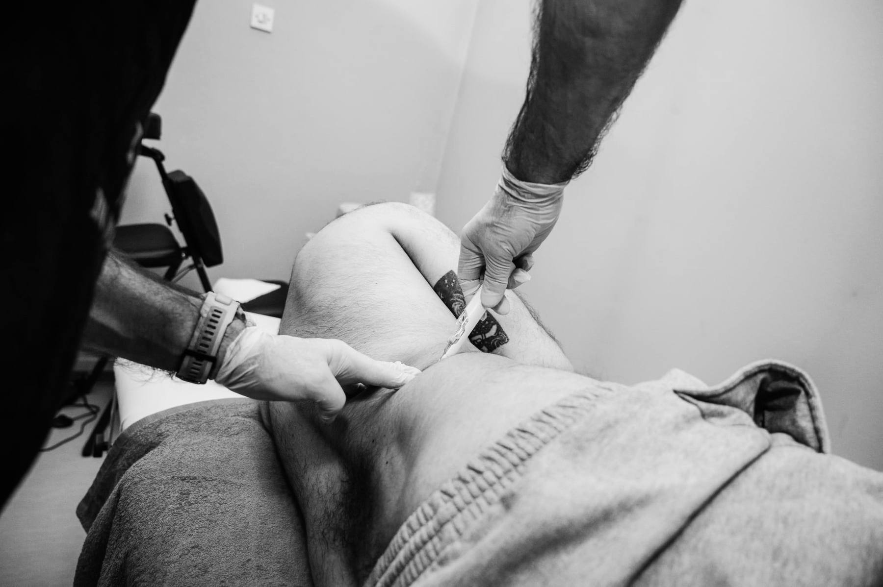 FSN needling terapija Tuzla